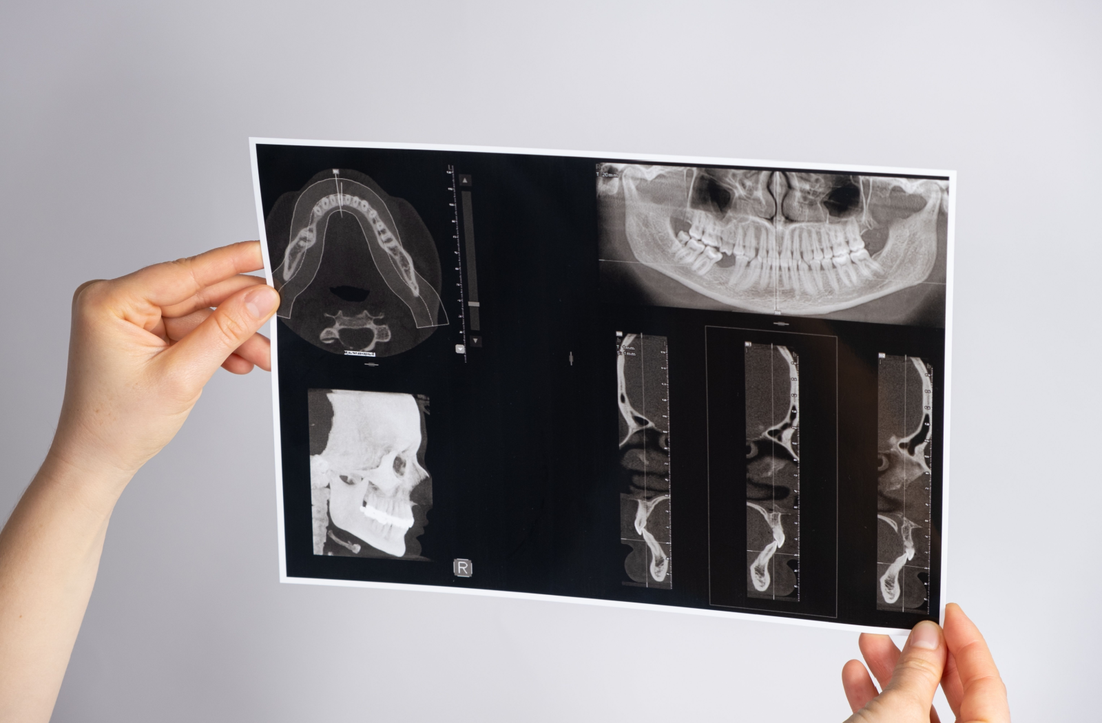 A dentist holds up an X-ray of a patient with TMJ and malocclusion in their jaw.