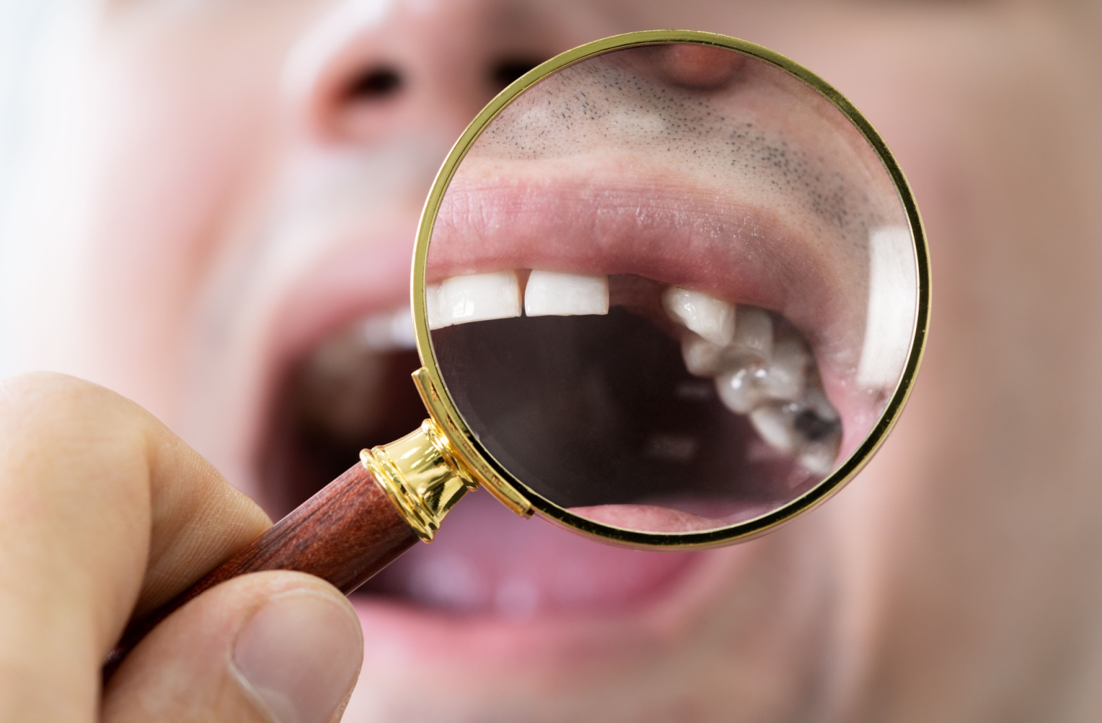 Close-up of missing tooth viewed through a magnifying glass held in front of an open mouth