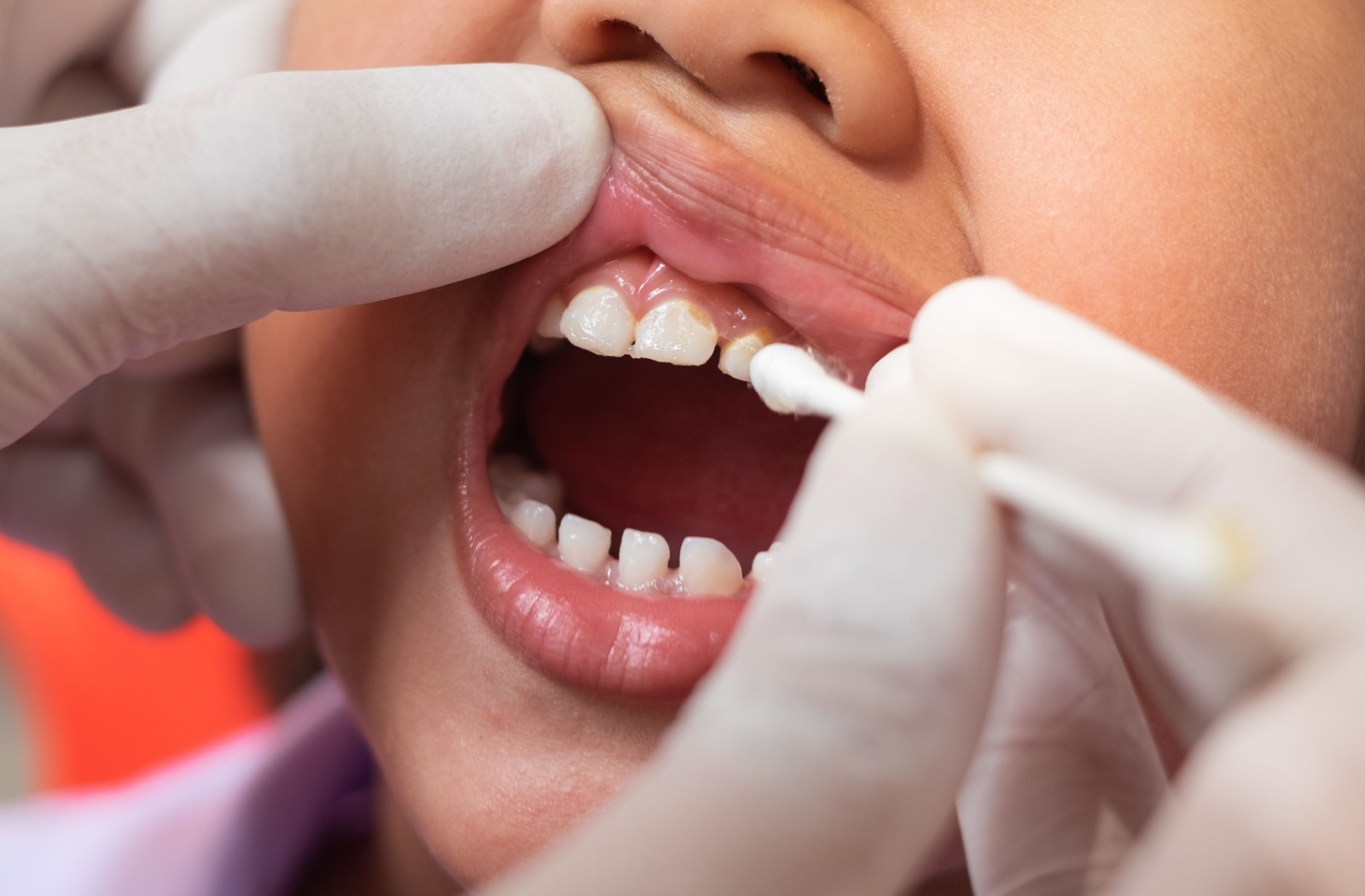 Close-up of a dentist applying fluoride varnish to a child’s teeth with a small brush during a dental appointment.