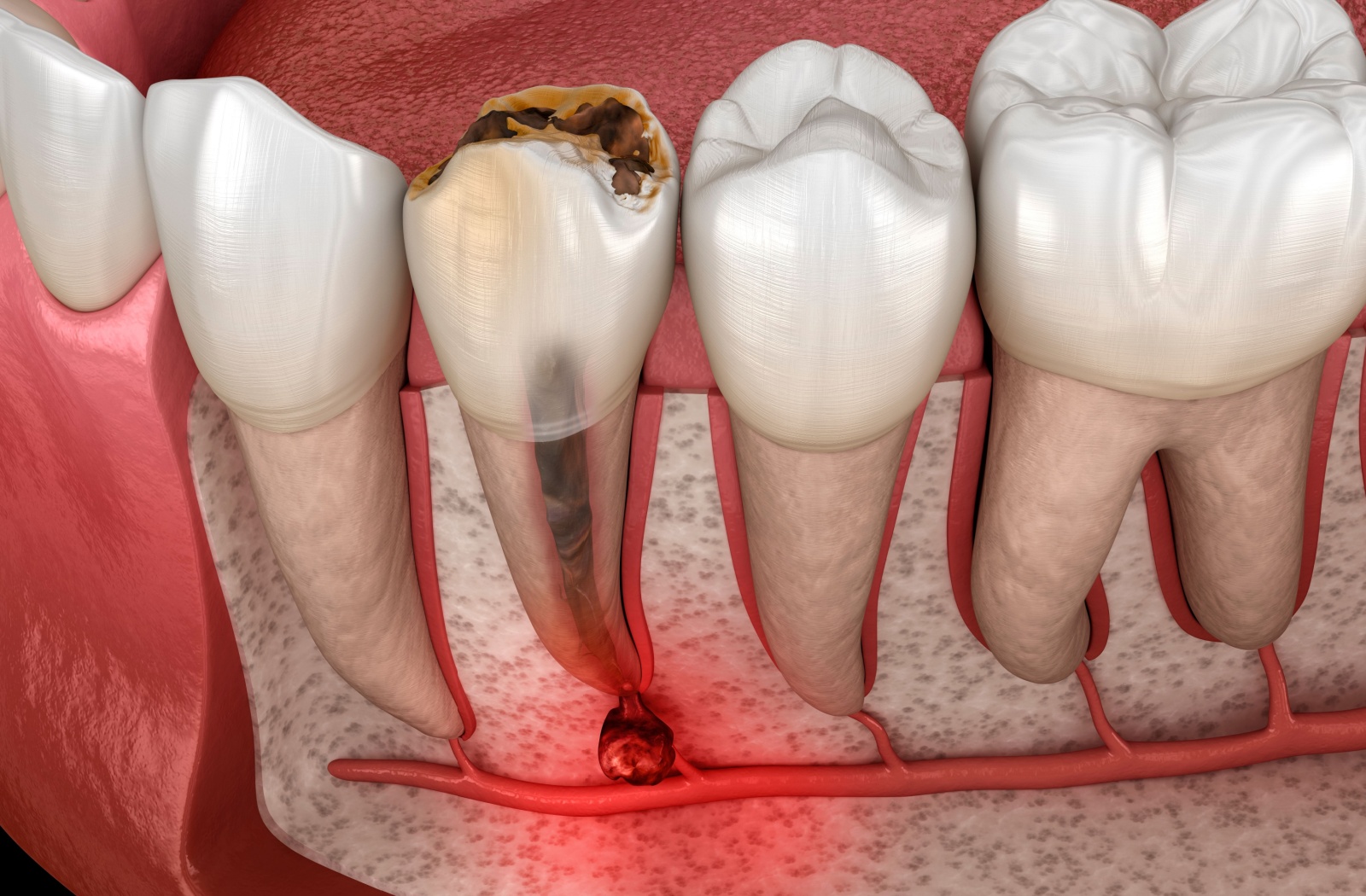 3D generated image of a decayed tooth with infected root.