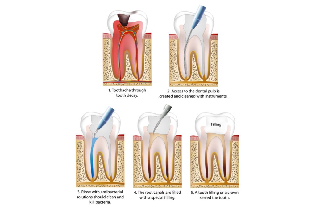 3D generated image of a decayed tooth with infected root.
