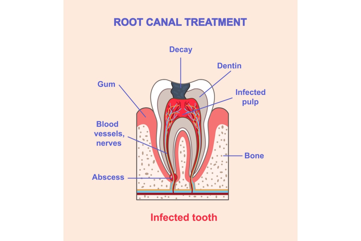 Medical diagram showing cross-section of infected tooth requiring root canal treatment with labeled anatomy including decay, dentin, infected pulp, blood vessels, nerves, bone, and abscess.