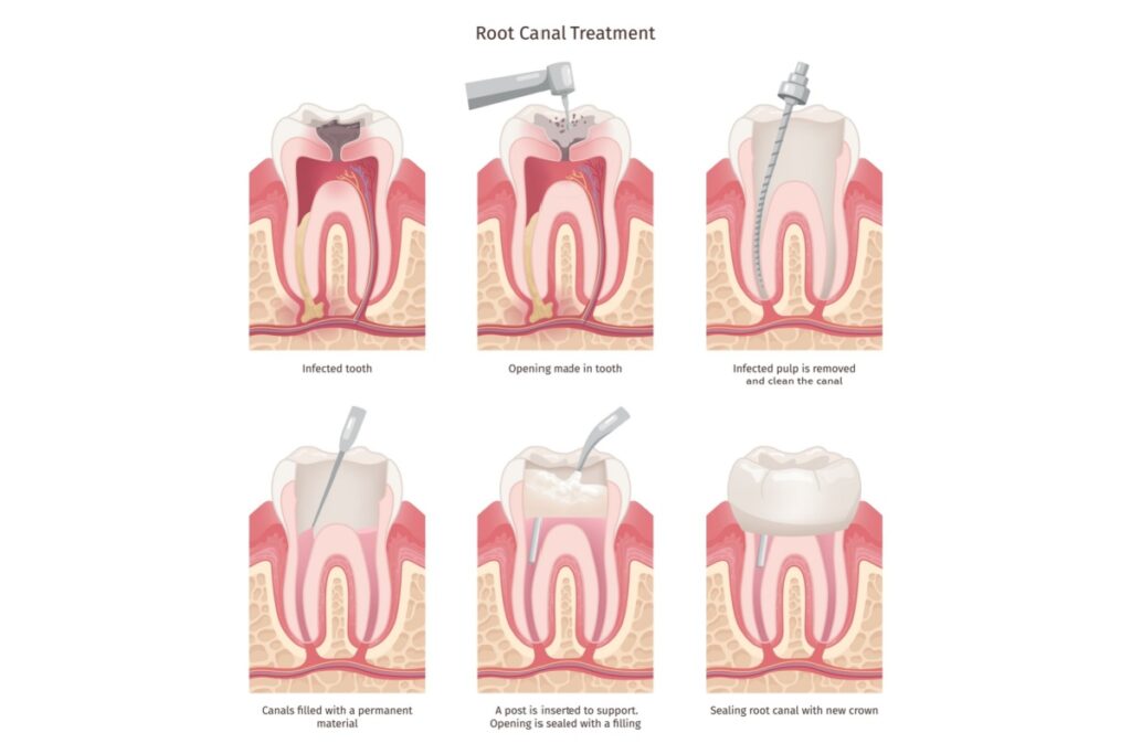 Medical illustration showing six-step root canal treatment process from infected tooth through opening, cleaning, filling canals, post insertion, and final crown placement.