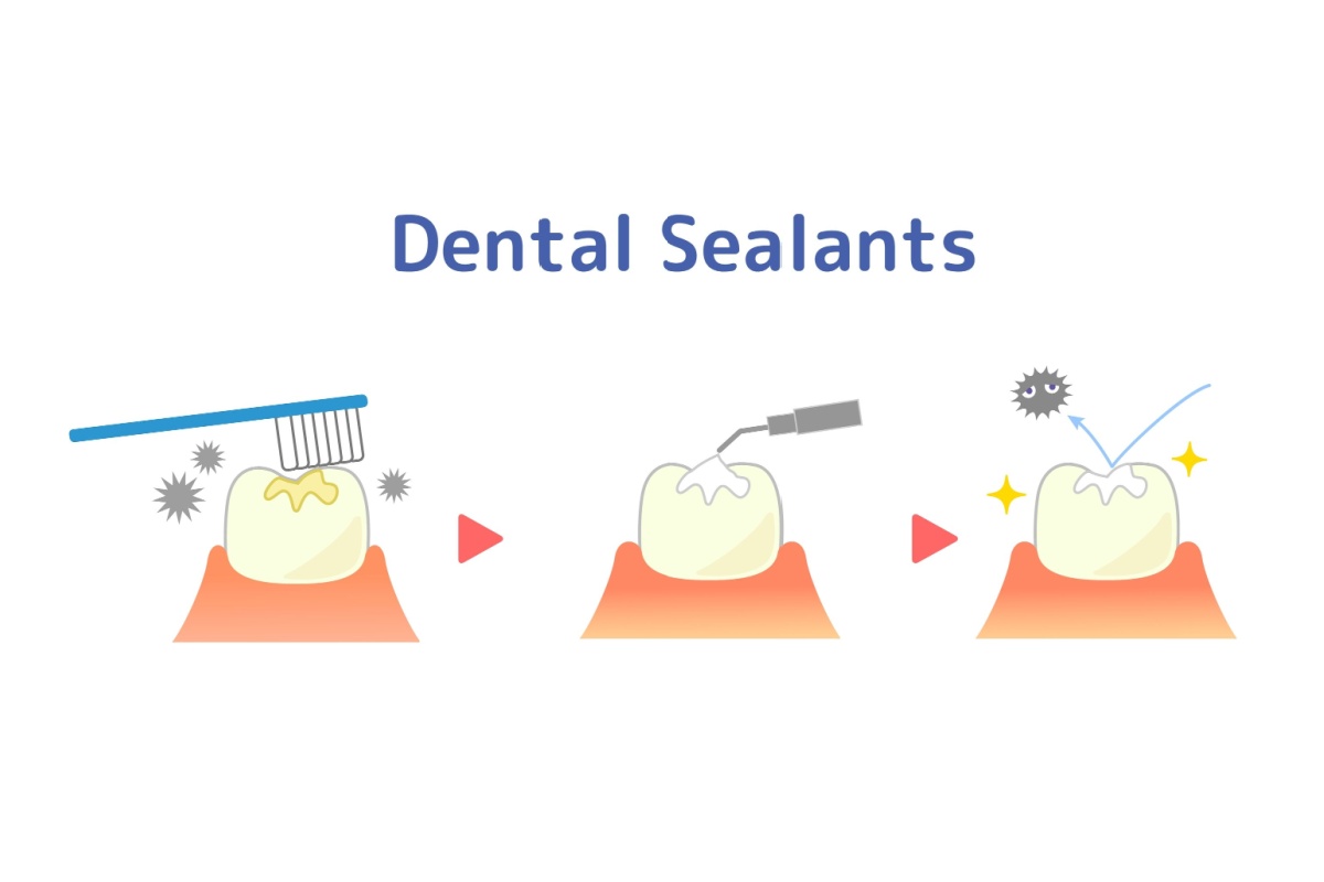 Three step dental sealants application illustration.